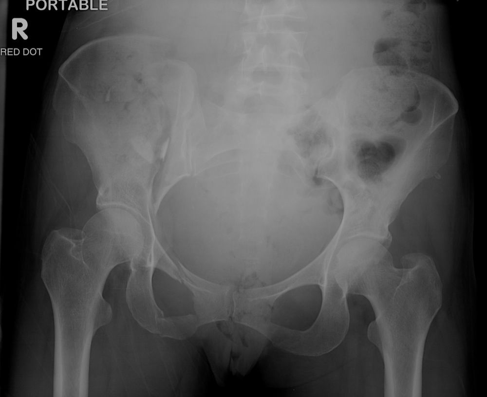 image-gallery-rami-fracture